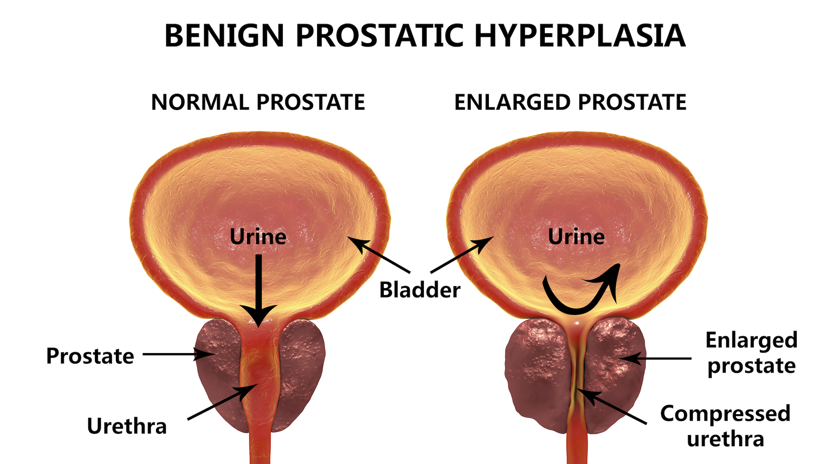 Enlarged Prostate Matthew Mutter MD