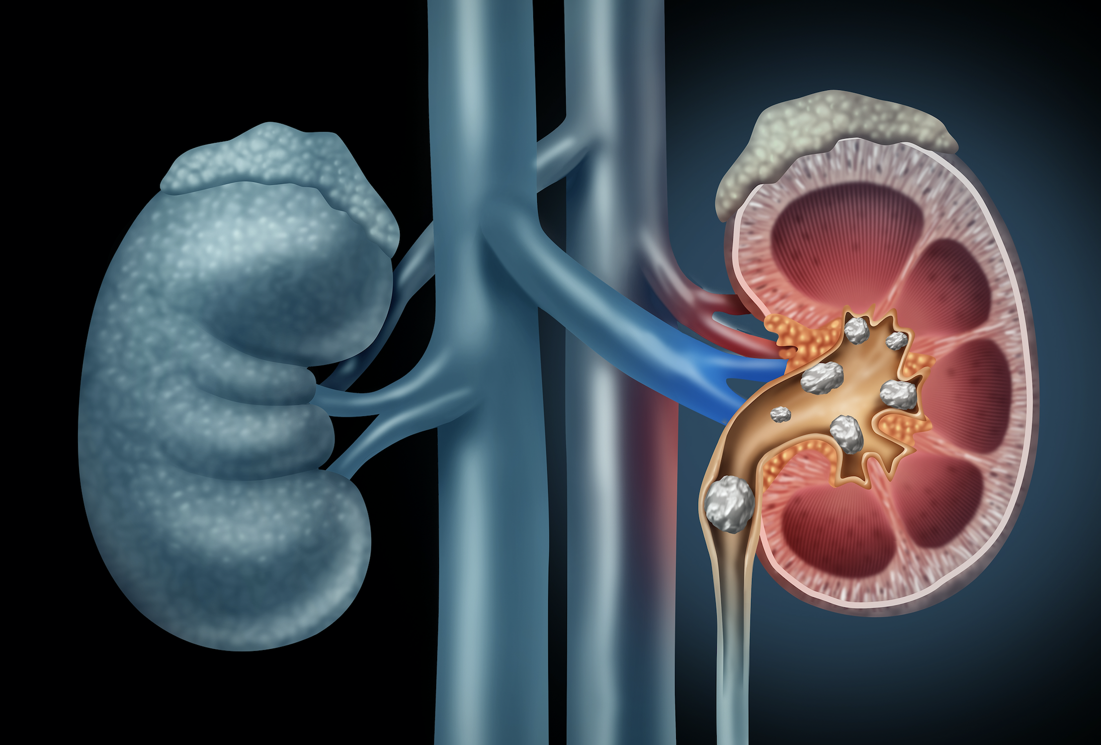 Kidney Stones Matthew Mutter MD